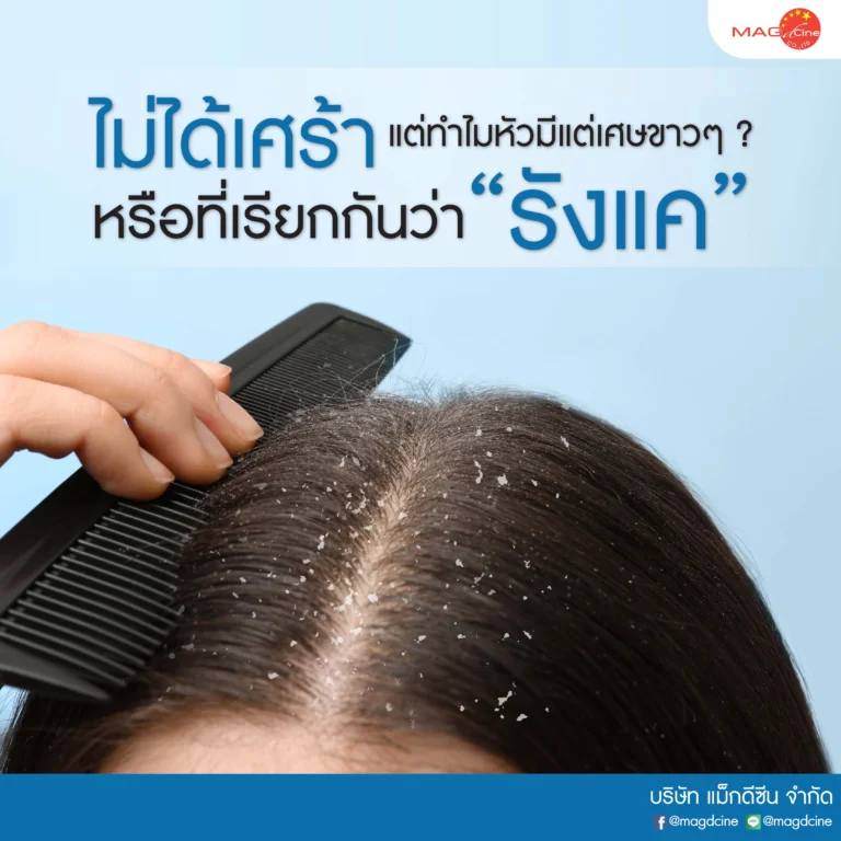 อาการ "ไม่ได้เศร้า แต่ทำไมหัวมีแต่เศษขาวๆ" หรือที่เรียกกันว่า "รังแค" แก้ได้ด้วย ทาร์แชมพู