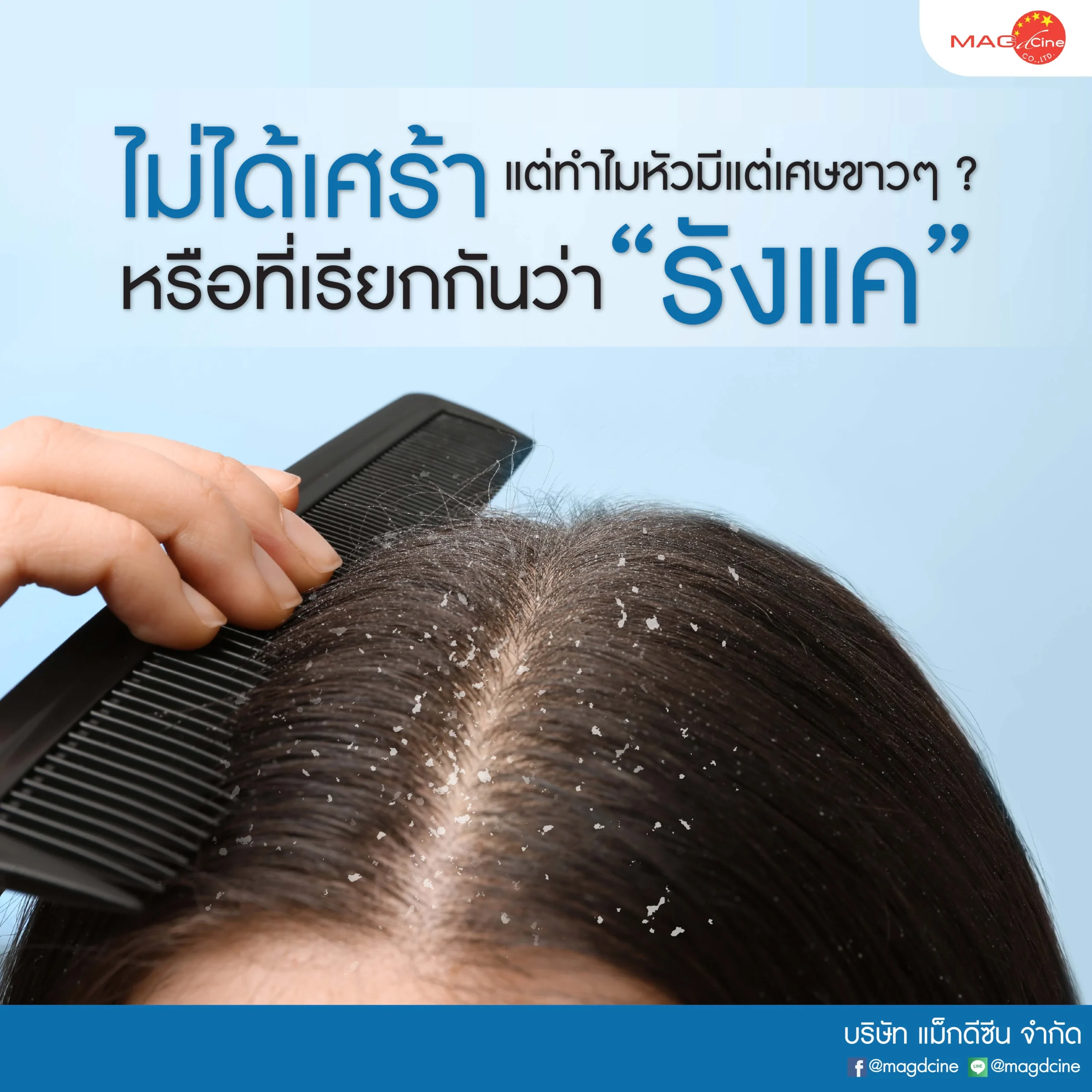 อาการ "ไม่ได้เศร้า แต่ทำไมหัวมีแต่เศษขาวๆ" หรือที่เรียกกันว่า "รังแค" แก้ได้ด้วย ทาร์แชมพู