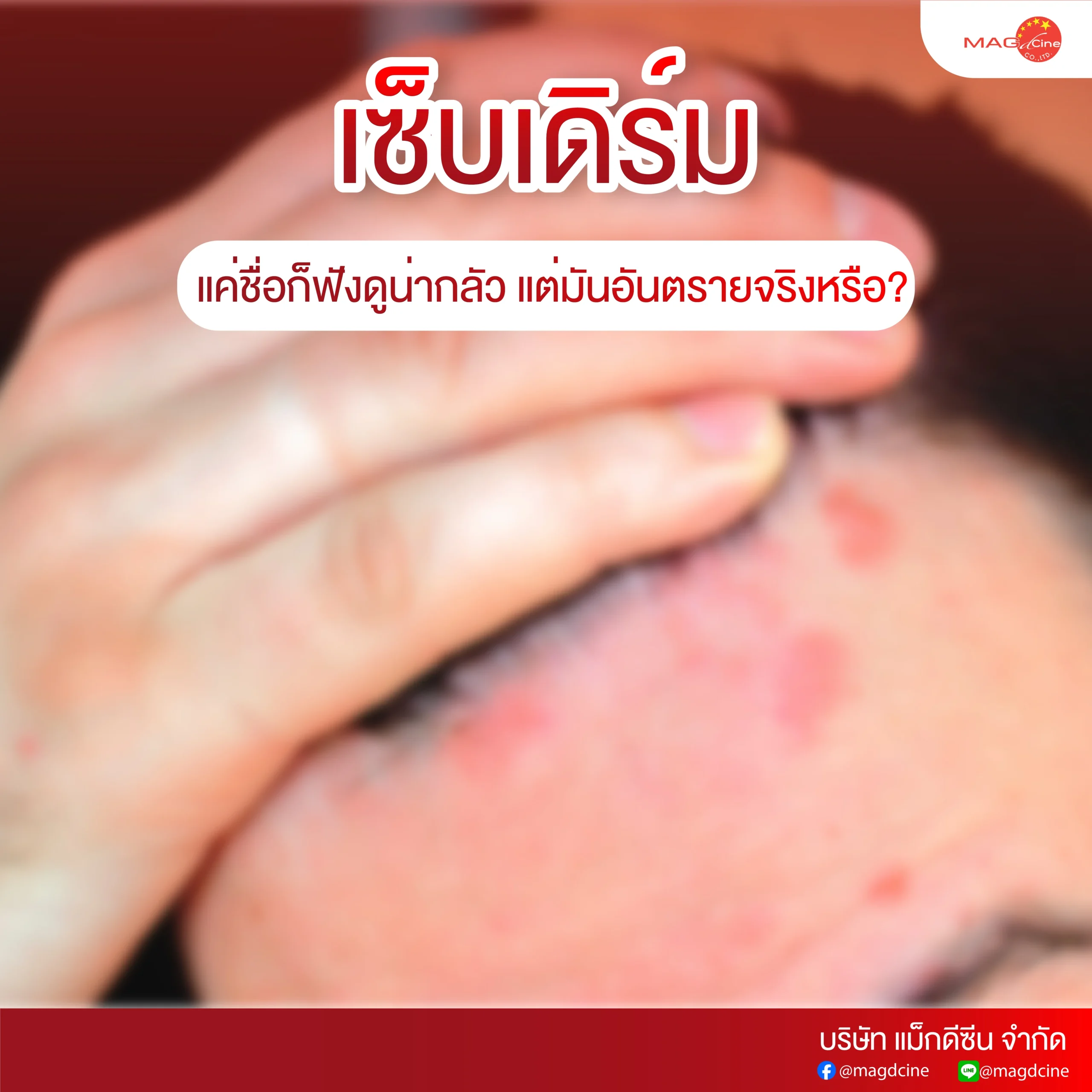 เซ็บเดิร์ม scaled บทความ